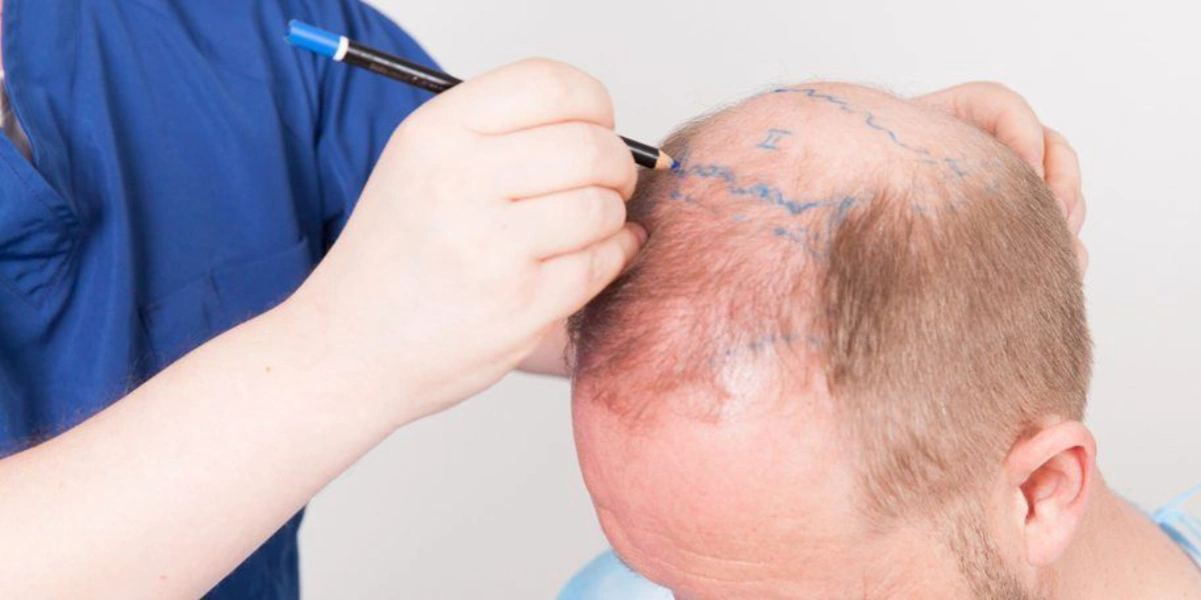 Hair Transplant in Dubai | Expert Hair Restoration Solutions